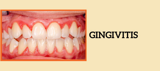 Gingival Inflammation or Gingivitis