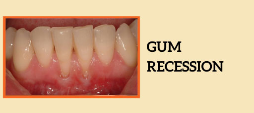 Gum Recession