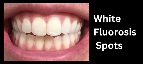 Dental Fluorosis: Symptoms, Causes, And Treatments (2023)