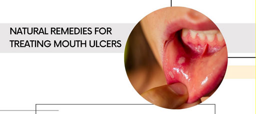 Natural Remedies for Mouth Ulcer Treatment