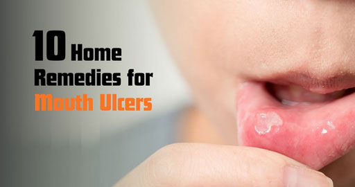 Home Remedies for Mouth Ulcers