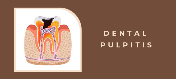 Dental Pulpitis
