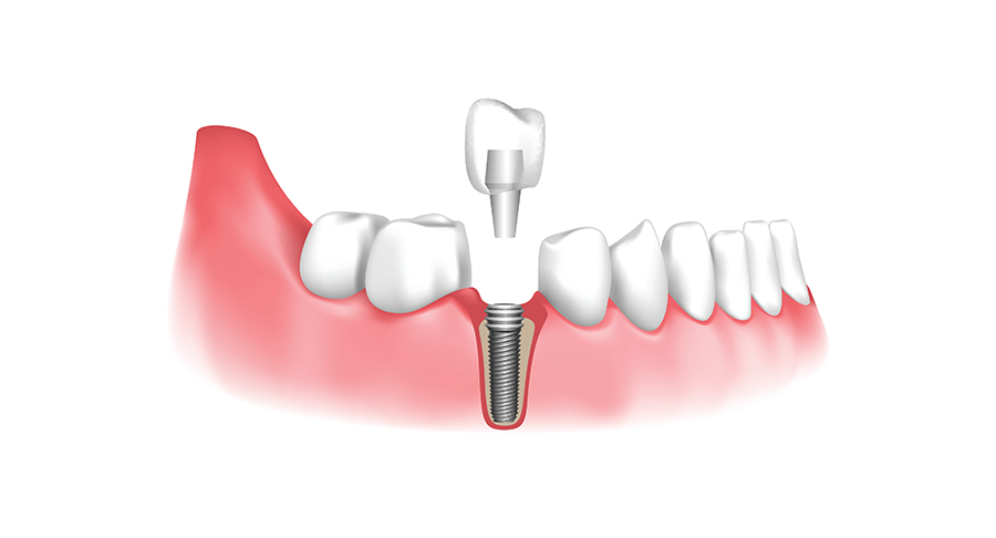 Single Dental Implant Cost in India