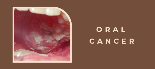 Oral Cancer Detection and Treatment Guide