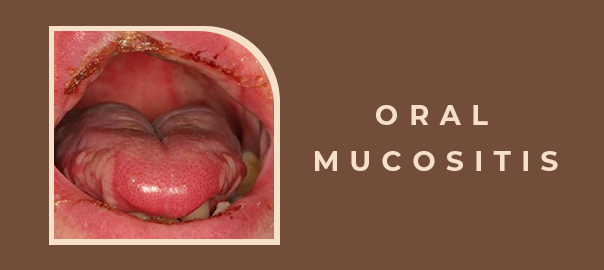 Oral Mucositis Management and Care