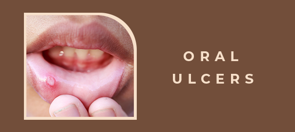 Oral Ulcer Treatment Options