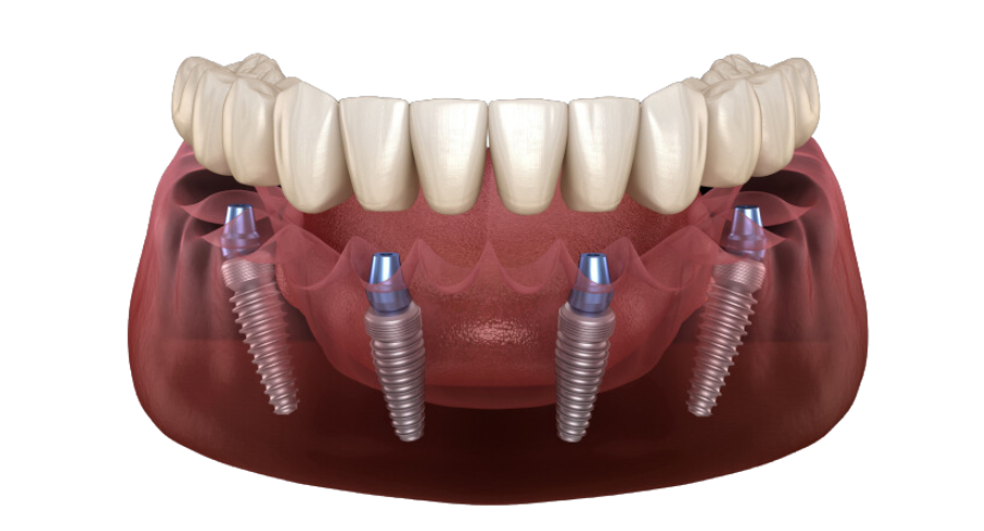 All on 4 Dental Implants Cost in India
