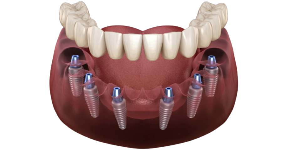 All on 6 Dental Implants Cost in India