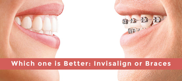 Invisalign and braces