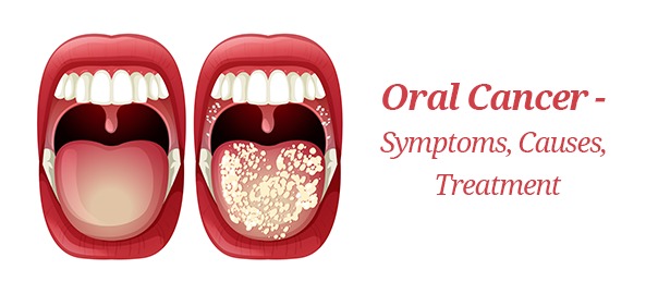 oral cancer