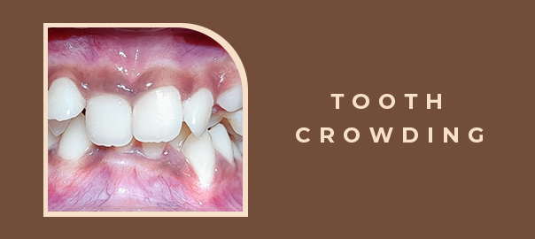 crowding of teeth