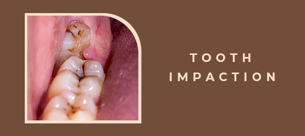 tooth impaction symptoms