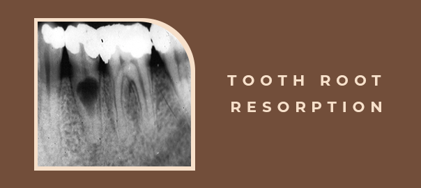 tooth root resorption