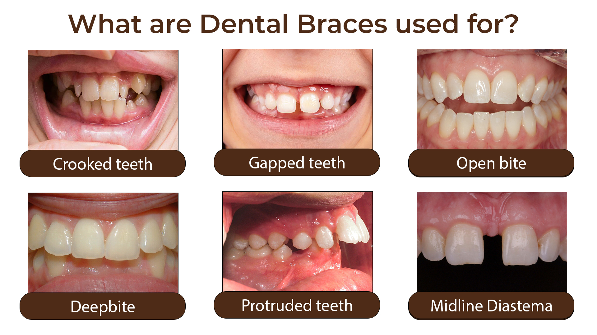 Dental Braces Correct Several Teeth Issues