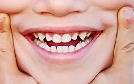 Smiling Kid after Kids Dentistry Treatment