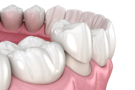 Dental Crowns (Teeth Cap)
