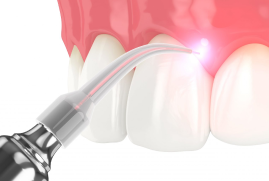 Laser Dentistry