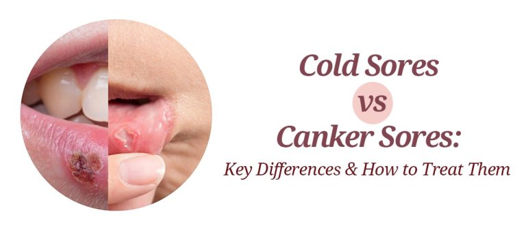 Cold Sores vs. Canker Sores