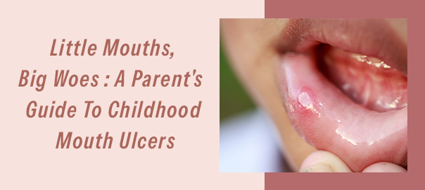 mouth ulcer treatment