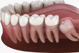 Wisdom tooth