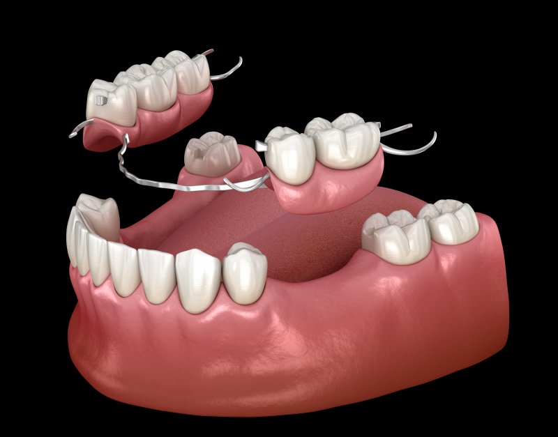 dental implants