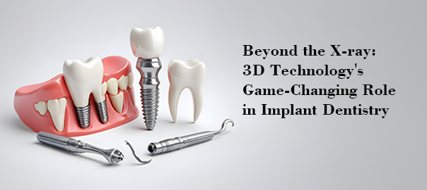 dental implants