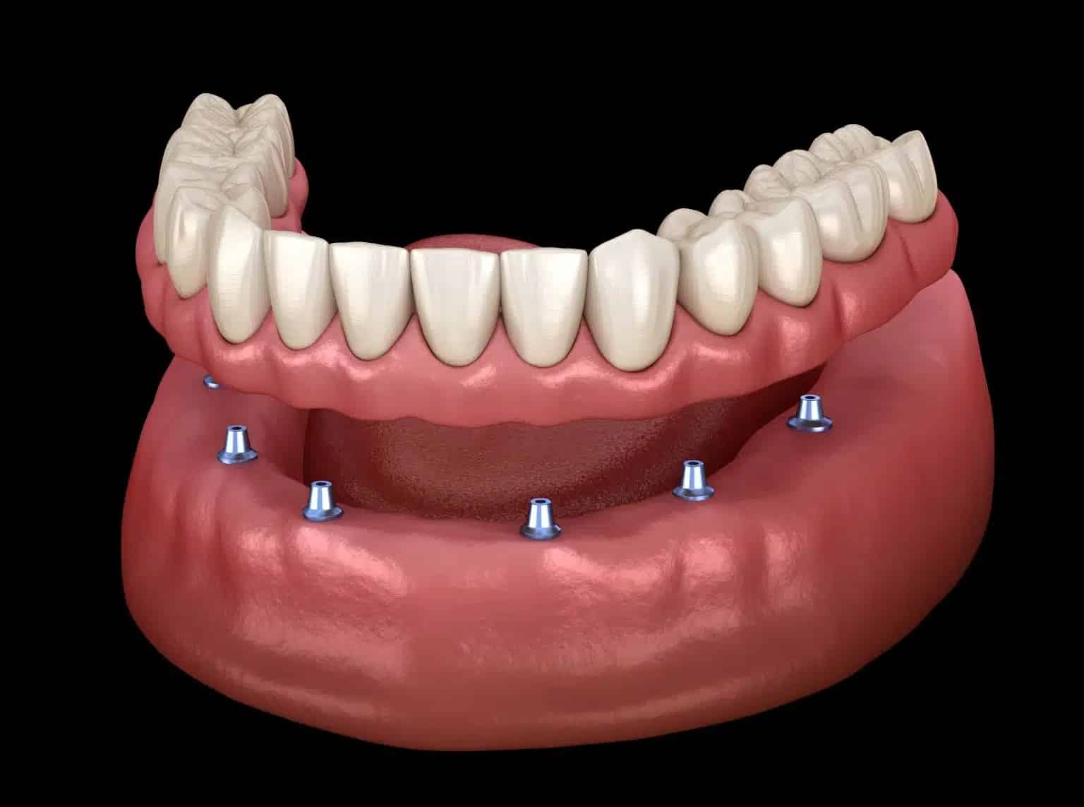 dentures price