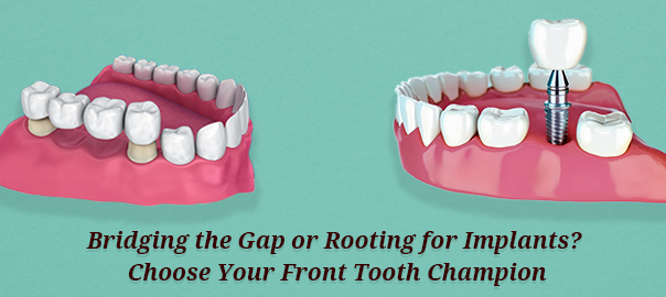 Gap or Rooting for Implants