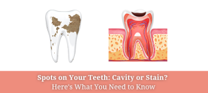 cavity vs stain