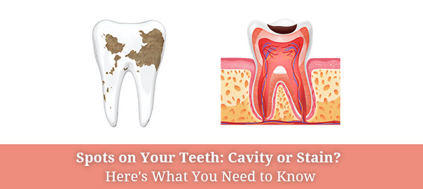 cavity vs stain