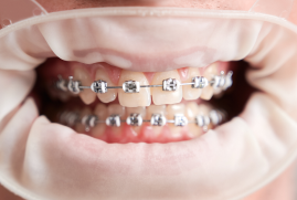 Dental Braces at Clove Dental