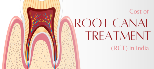 RCT cost in india