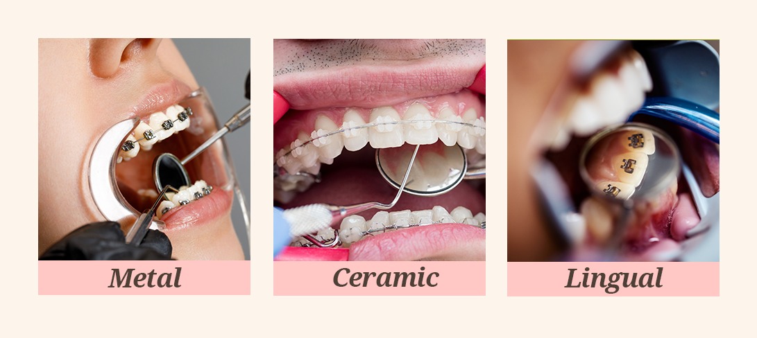 types of braces 