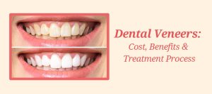 Dental Veneers Cost